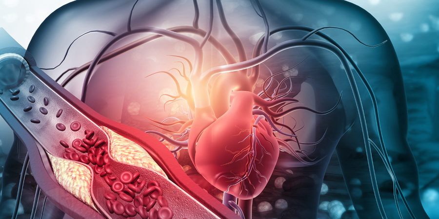 Menschliches Herz mit blockierten Arterien. 3D-Darstellung