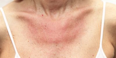 Frau mit Sonnenbrand und allergischer Reaktion nach ungeschütztem Sonnenbaden, akuter Zustand