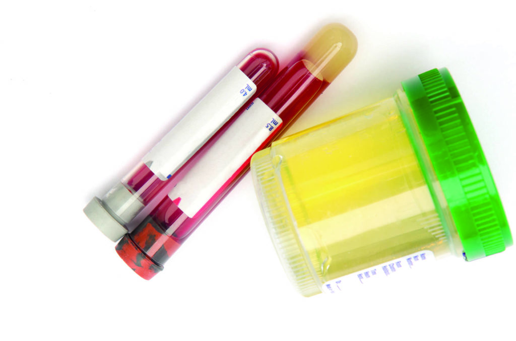 Sterile Urinprobe mit einem gefüllten Glas und einem mit intaktem sterilem Etikett