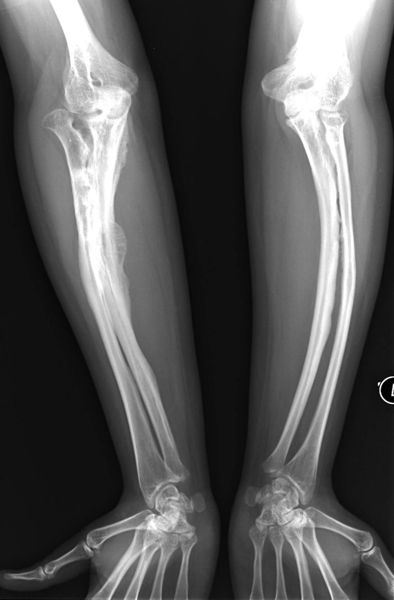 Osteogenesis imperfecta im Erwachsenenalter Medical Tribune Schweiz