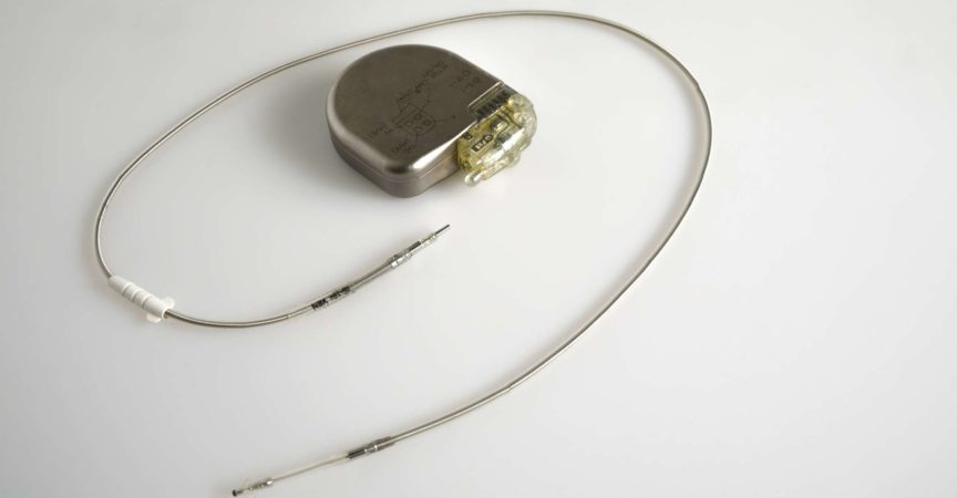 Ein implantierbarer Kardioverter-Defibrillator oder ein ICD-Schrittmacher mit Elektroden. Dieser wird in der Brust platziert, um einen plötzlichen Tod zu verhindern, wenn Patienten eine ventrikuläre Tachykardie oder Kammerflimmern erlitten haben
