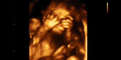 Baby 3D Ultraschall 6 Monate