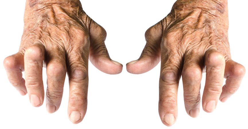 Alte Frauenhände deformiert von rheumatoider Arthritis isoliert auf weißem Hintergrund