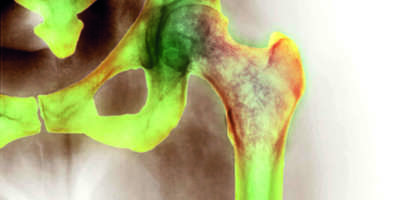Osteoporosis of the hip,X-ray