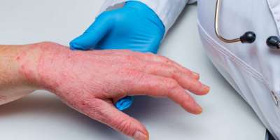 Arzt in Handschuhen untersucht die Haut der Hand eines kranken Patienten. Chronische Hautkrankheiten - Psoriasis, Ekzeme, Dermatitis.