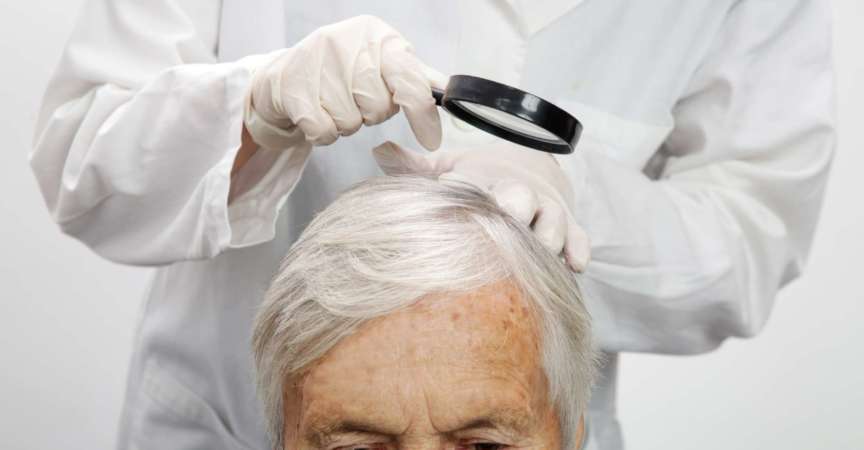 Arzt untersucht die Kopfhaut einer älteren Frau, Kopfhautekzem, Dermatitis, Psoriasis, Haarausfall, Schuppen oder trockene Kopfhaut