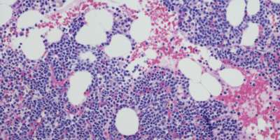 Mikroskopische Aufnahme einer Myelom-Neoplasma-Knochenmarkbiopsie. Hämatoxylin- und Eosin-Färbung
