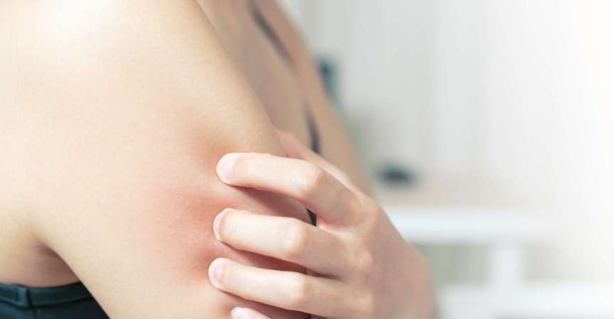Frauen kratzen den Juckreiz am Arm-, Gesundheits- und Medizinkonzept.