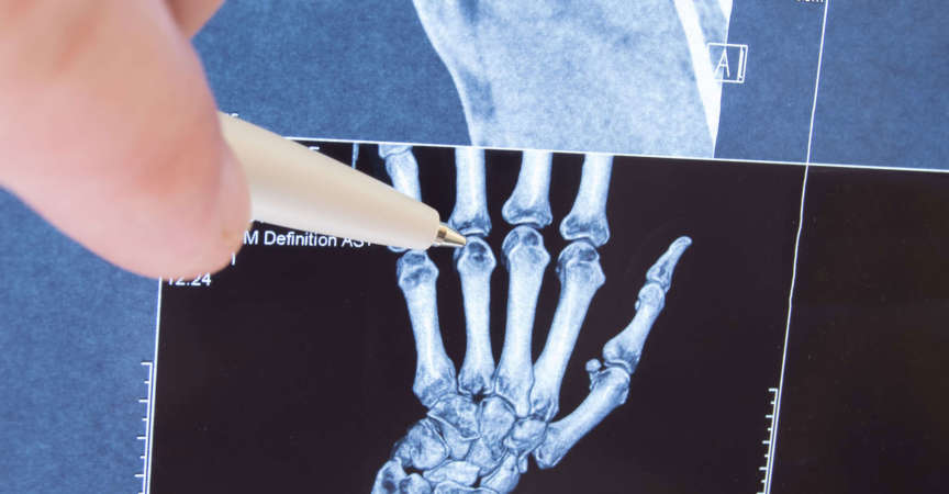 Röntgen eines Handskelett
