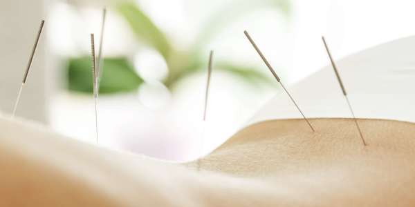 Alternative medicine. Close-up of female back with steel needles during procedure of acupuncture therapy.