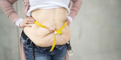 Eine Frau hat durch eine Magenverkleinerung sehr viel Gewicht verloren. Sie zeigt Ihren Bauch auf diesem Bild