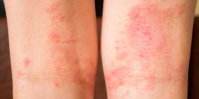 Selektiver und weicher Fokus auf rote Allergieflecken und Hautentzündungen an den Füßen des Kindes