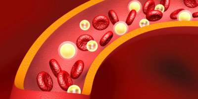 LDL-Cholesterin in den Arterien. 3D-Darstellung