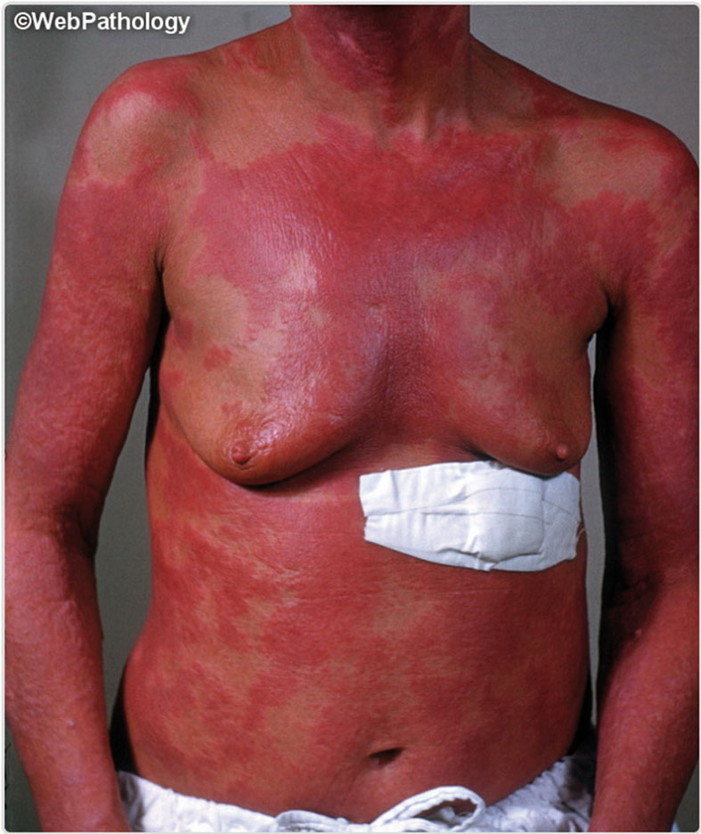 Körper einer Frau mit roten Flecken