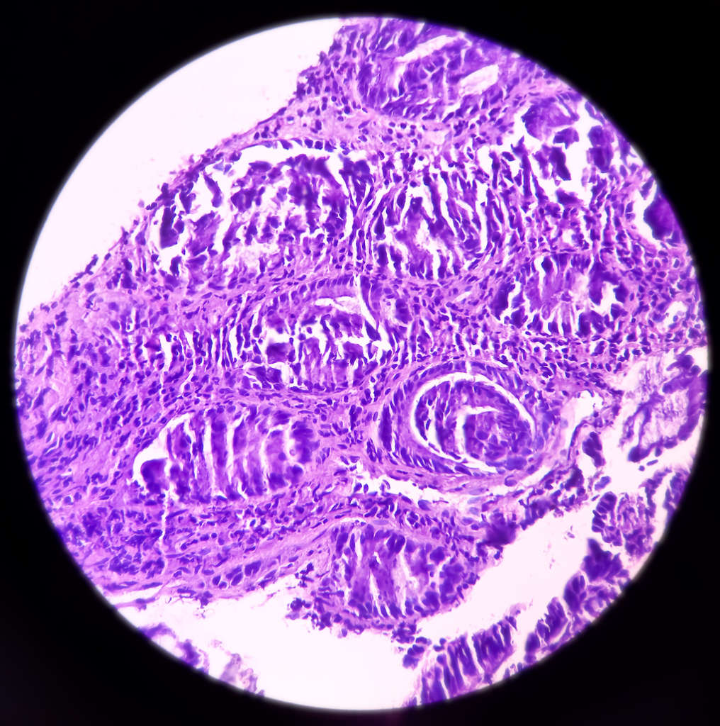 Darmkrebs unterm Mikroskop