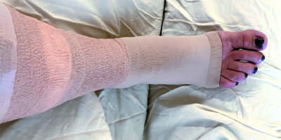 Bandagiertes Bein, das sich von einem chirurgischen Eingriff erholt