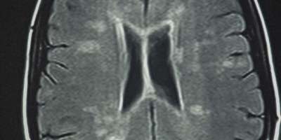 Magnetresonanztomografie von einem menschlichen Gehirn mit Multipler Sklerose