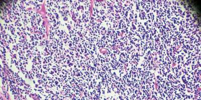 Hodgkin-Zellen-Krankheit, Lymphom, HL unter dem Mikroskop Zoom in verschiedenen Bereichen