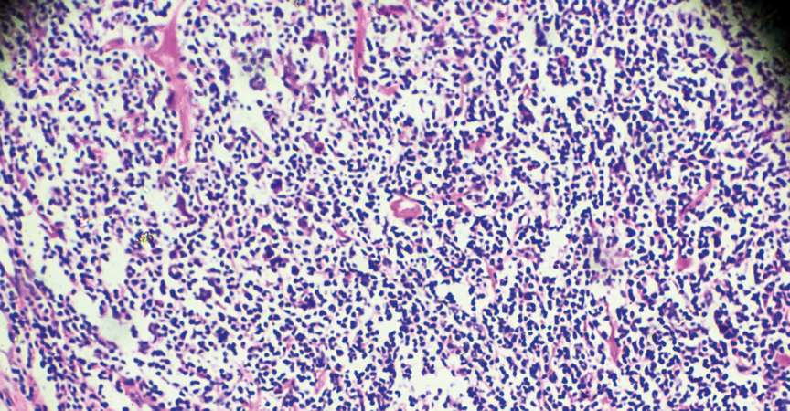Hodgkin-Zellen-Krankheit, Lymphom, HL unter dem Mikroskop Zoom in verschiedenen Bereichen