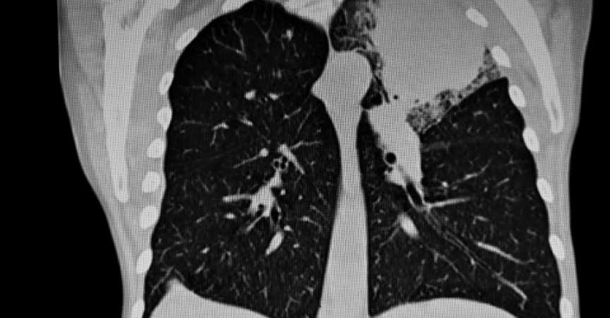 CAT-Scan: Tumor der linken oberen Lunge