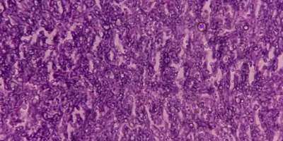 Pilzinfektion der Lunge, mikroskopisches Bild: Eine Hämatoxylin- und Eosin-Färbung zeigt Pilzhyphen einer histologischen Gewebeblockprobe.