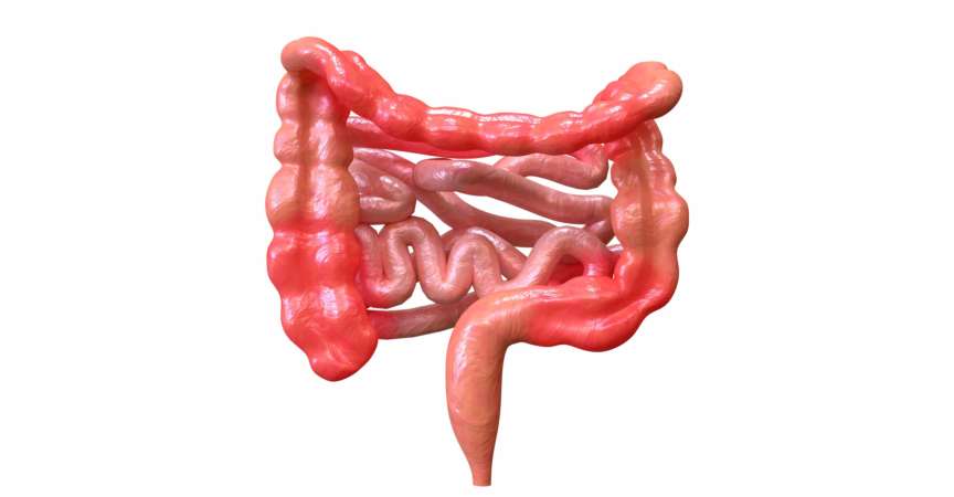 Morbus Crohn ist ein Syndrom, das das Verdauungssystem betrifft. Seine Symptome sind Bauchschmerzen in Verbindung mit Durchfall, Fieber, Gewichtsverlust und Schwäche