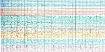 Gehirnwellen von Epilepsiepatienten
