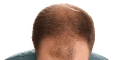 Der androgenetisch bedingte Haarverlust beginnt beim Mann typischerweise an den Schläfen, bei der Frau am Scheitel.