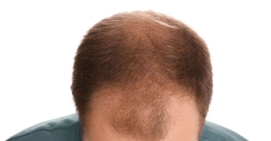 Der androgenetisch bedingte Haarverlust beginnt beim Mann typischerweise an den Schläfen, bei der Frau am Scheitel.