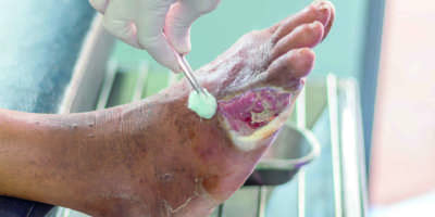 infizierte Wunde des diabetischen Fußes