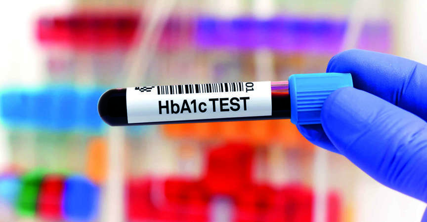 Blutprobe zur Untersuchung von HbA1c oder Hämoglobin A1c zum Nachweis von Diabetes