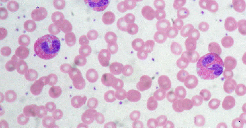 Eine ausgeprägte Eosinophilie im Blutbild gab den entscheidenden Hinweis