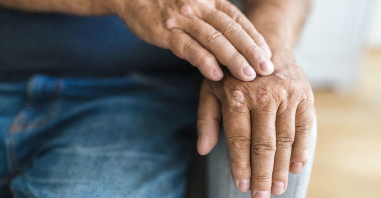 Älterer Mann, der an Psoriasis leidet, Nahaufnahme an den Händen