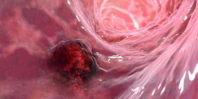 Darmkrebs, Darmkrebs, Darmneoplasie, 3D-Darstellung mit bösartigem Tumor im Darm