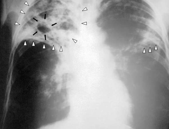 Nach Aufenthalten in Risikogebieten zahlt sich ein Test auf Tuberkulose aus.