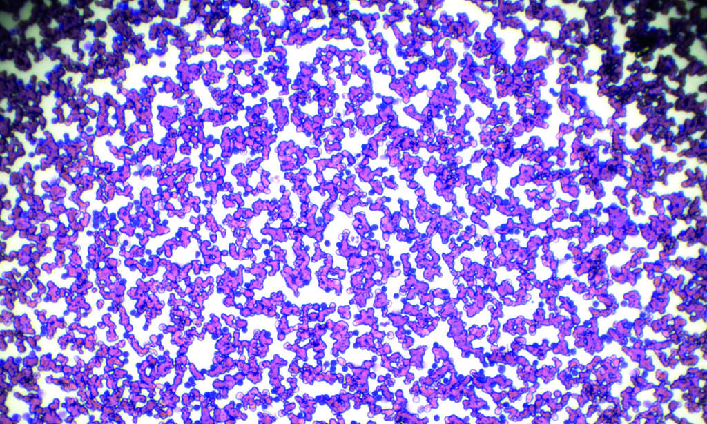 Chronic lymphocytic leukemia (CLL) blood smear under light microscopy