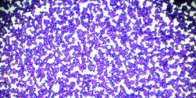 Chronic lymphocytic leukemia (CLL) blood smear under light microscopy