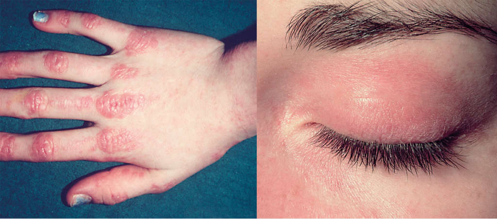 Gottron-Papeln, flache, rötlich-livide Papeln und Plaques auf den Streckseiten von Händen und Fingern (li.), sind typisch für die Dermatomyositis, ebenso wie lilafarbene, ödematöse Erytheme der Oberlider (re.).