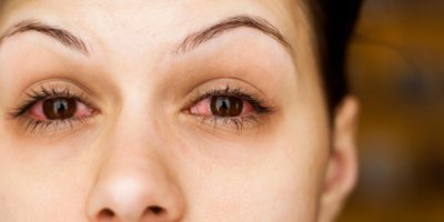 Frau mit Dermatologische Nebenwirkungen am Auge