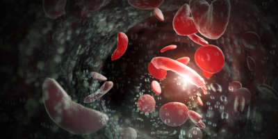 Blutkörperchen der Sichelzellenanämie (SCD) 3D-Darstellung
