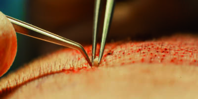 Haartransplantation – Hohe Therapiezufriedenheit bei Patienten