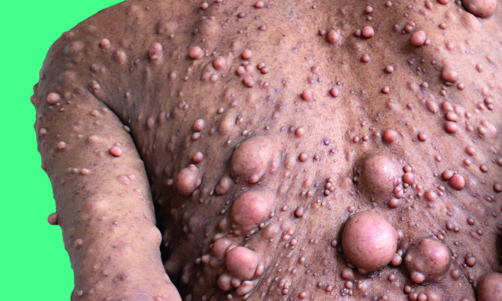 Neurofibromatosis (NF) is conditions in which tumors grow, symptoms include light brown spots on the skin.