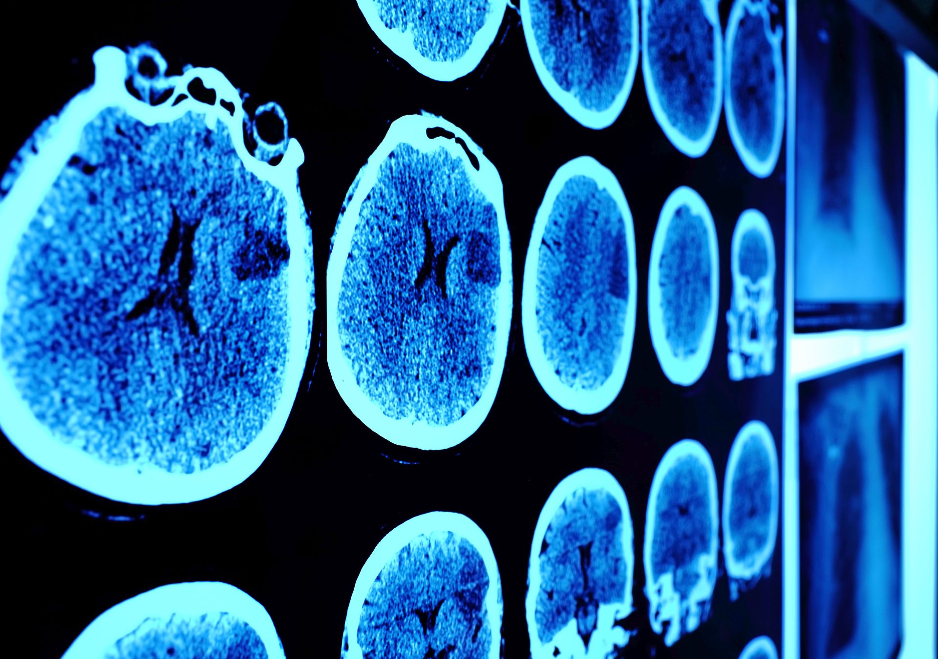 Funktionelle neurologische Störungen: Endlich Schluss mit der Ausschlussdiagnose