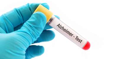 Reagenzglas mit Blutprobe für den Alzheimer-Test