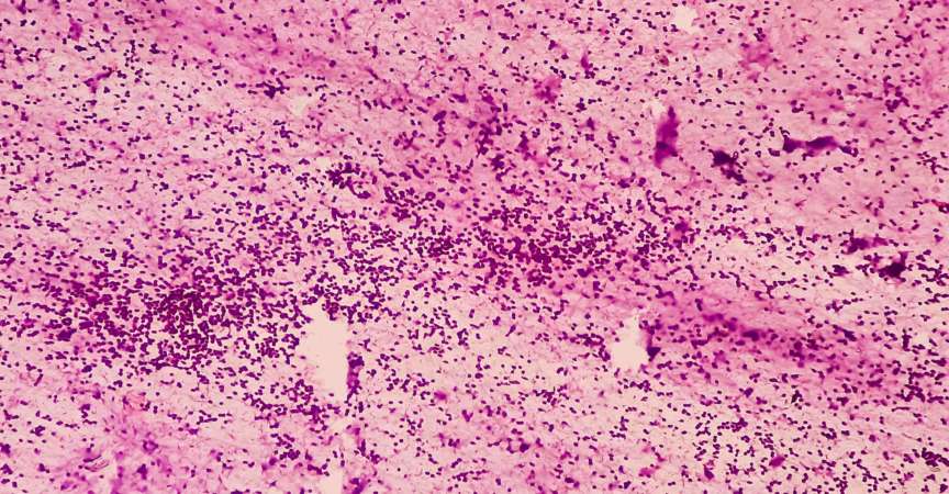 Mediastinale Raumforderung (CT-geführte FNA): Mikroskopisches Bild eines Thymoms, eines Tumors der Thymusdrüse, zeigt nekrotisches Material gemischt mit Lymphozyten, Myasthenia gravis.