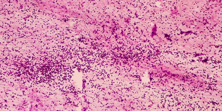 Mediastinale Raumforderung (CT-geführte FNA): Mikroskopisches Bild eines Thymoms, eines Tumors der Thymusdrüse, zeigt nekrotisches Material gemischt mit Lymphozyten, Myasthenia gravis.