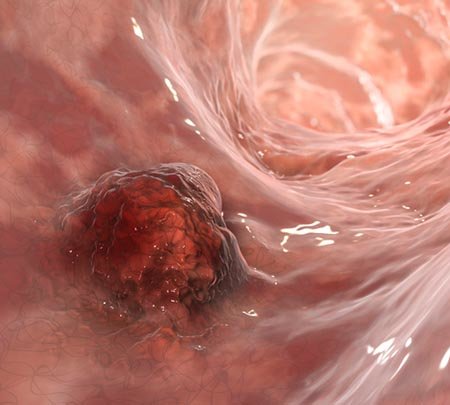 Colorectal cancer, intestinal carcinoma, bowel neoplasia, 3D illustration showing malignant tumor in intestine