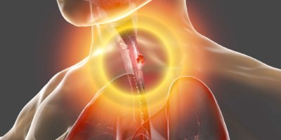 Speiseröhrenkrebs, 3D-Darstellung, die einen bösartigen Tumor in der menschlichen Speiseröhre zeigt