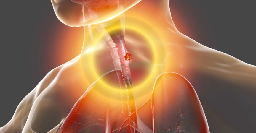 Speiseröhrenkrebs, 3D-Darstellung, die einen bösartigen Tumor in der menschlichen Speiseröhre zeigt