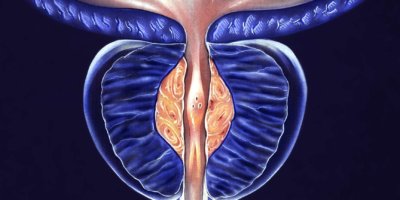 Prostata – (BPH) Benigne Prostatahyperplasie, Stufe 1 – falsche Farbe, um Details hervorzuheben